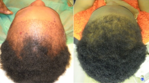 Implant capillaire sur cheveux crépus